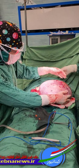 تصاویر خارج کردن توده 8 کیلویی عجیب از شکم زنی در گچساران