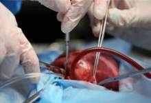 اهدای اعضاء بدن بیمار مرگ مغزی در یاسوج