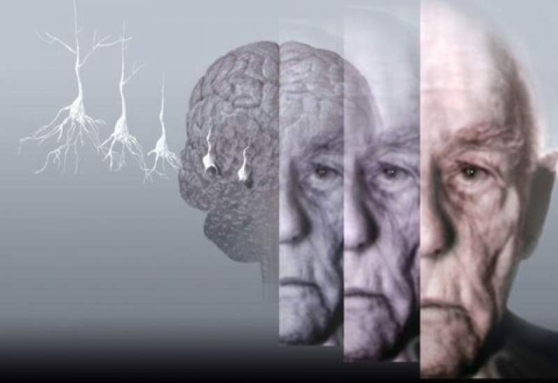 عامل ابتلا به آلزایمر پس از صدسال کشف شد