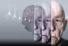 عامل ابتلا به آلزایمر پس از صدسال کشف شد