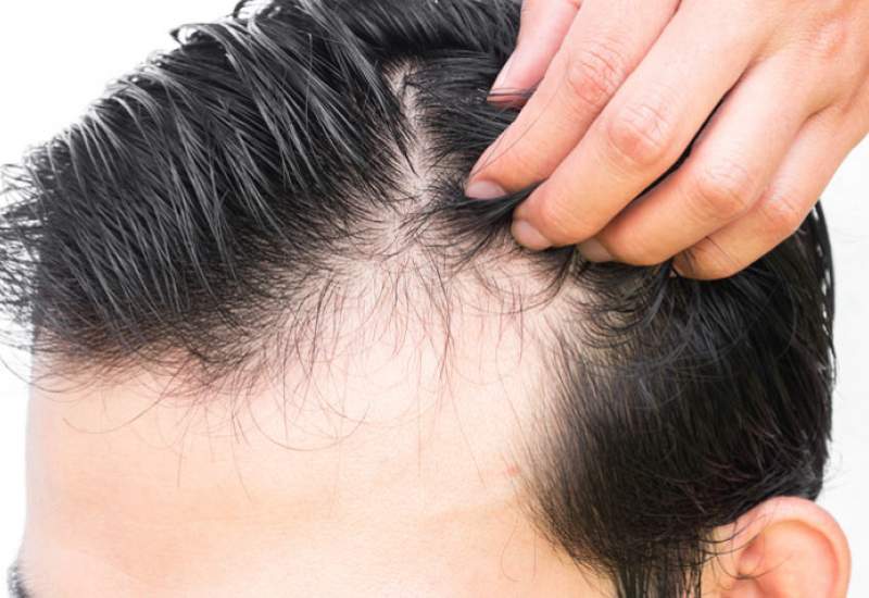 علت افزایش ریزش مو در بین ایرانی‌ها + روش جلوگیری