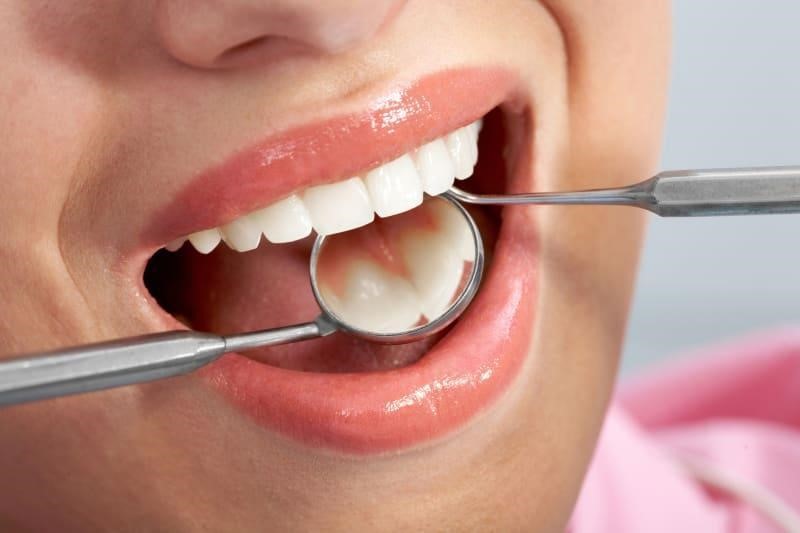 Composite Dental Fillings: What are they and when are they used? | Harker  Chan & Associates | Southeast Calgary Dentist
